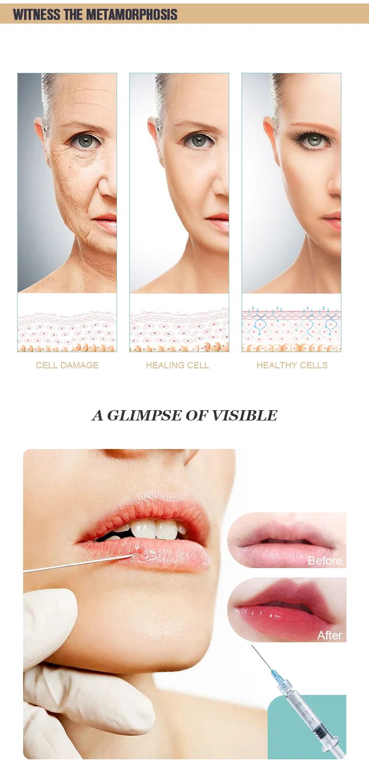 Upgrade Your Aesthetics Radies Se Dermal Filler with Lido