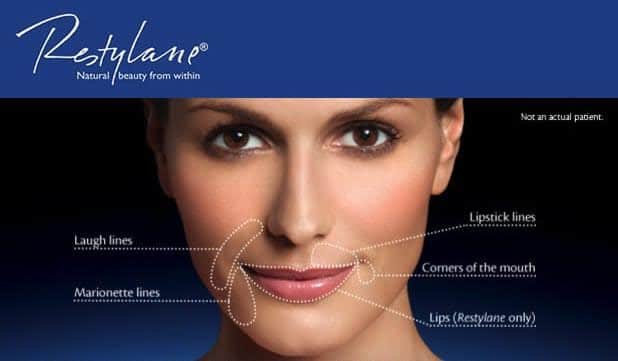 Restylane Williamsville NY - Facial Fillers Buffalo NY