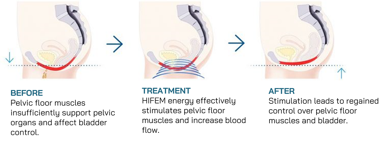 EVALASER Technology HIFEM Pelvic Floor Exercise machine