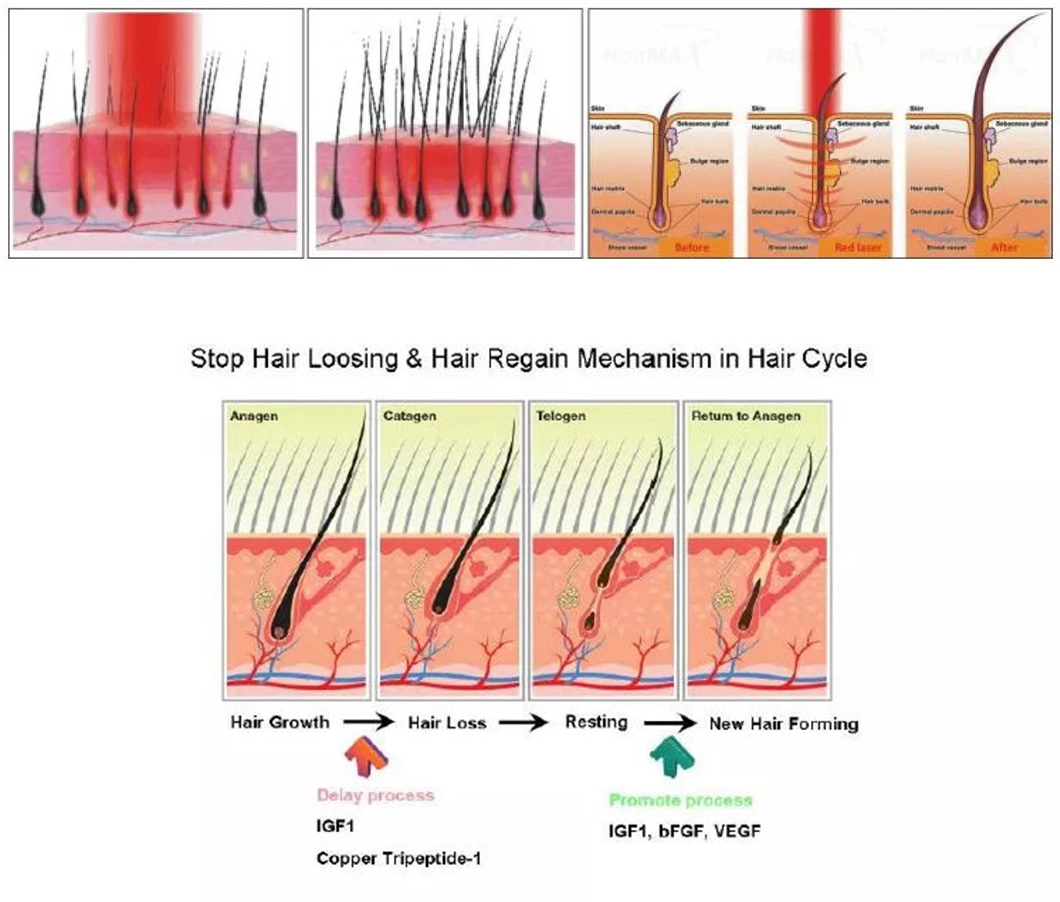 New 650nm Diode Laser Hair Regrowth for Doctors and Beauticians Use