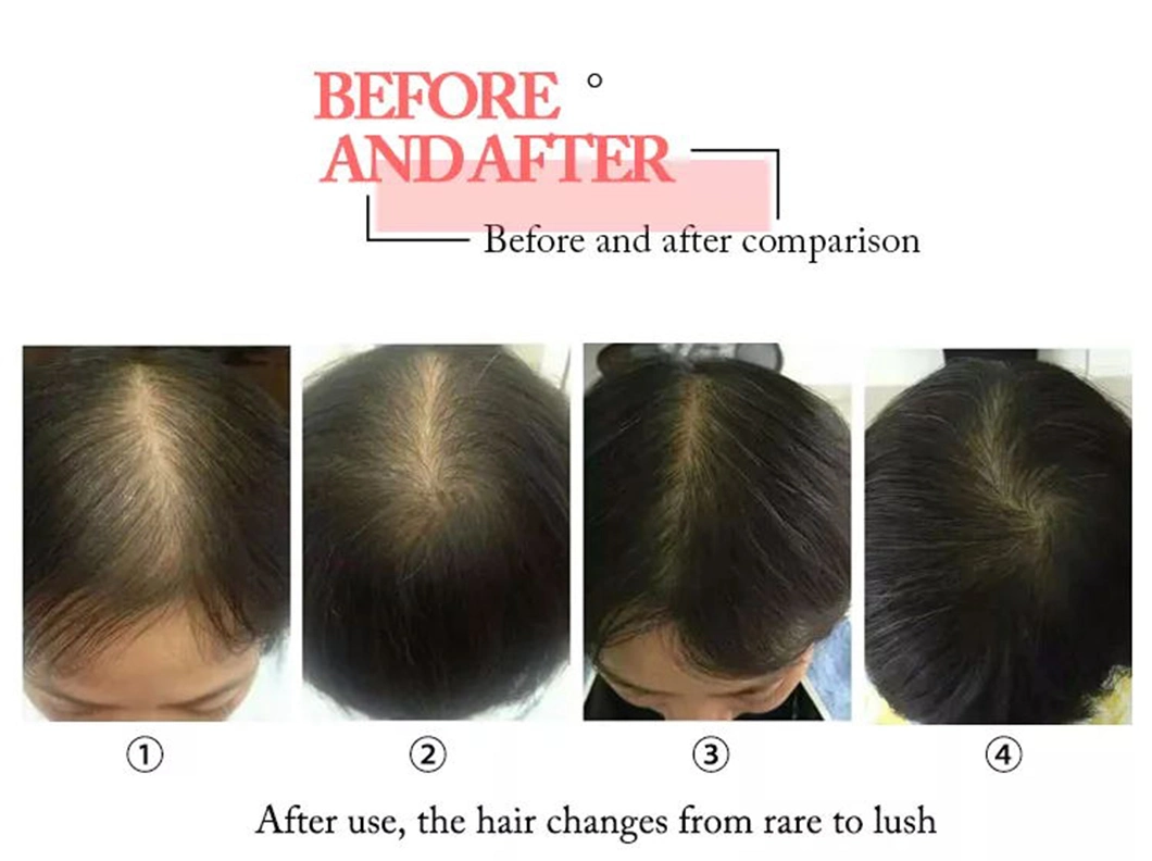 New 650nm Diode Laser Hair Regrowth for Doctors and Beauticians Use