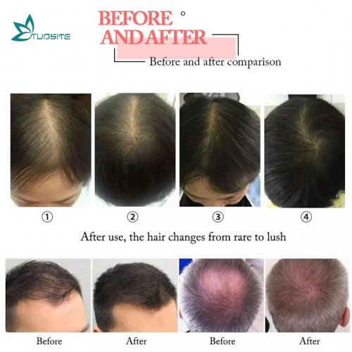 New Anti-Hair Loss Laser Diode Laser Hair Regrowth Beauty Equipment