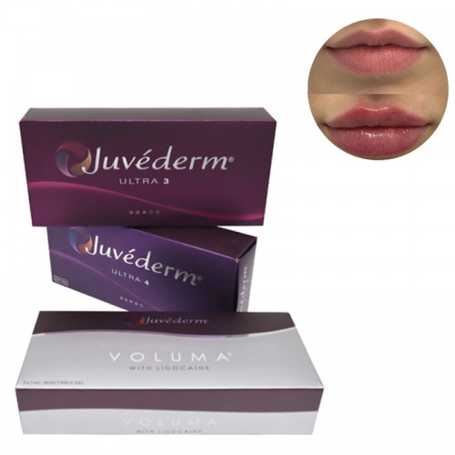 Juvederm Voluma Injection of Facial Dermal Filler the Volume of Cheeks and Chin