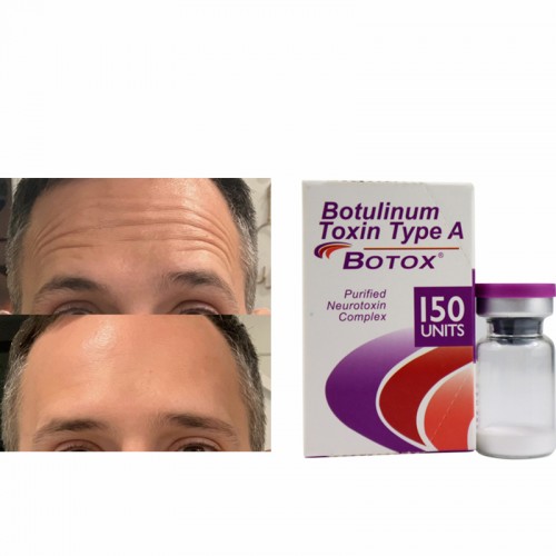 Botox Therapeutic Botulinum Toxin Type A ALLERGAN 100iu 150iu 500iu