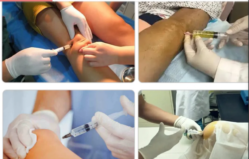 Knee Hyaluronic Acid Injection Non Cross Linked Dermal Filler