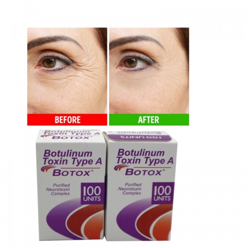 Botox Allergan Cosmetic Botulinum Toxin Type A